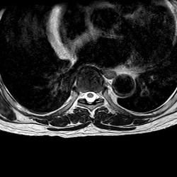 MRI_eAX_T2W_Thoracal_702
