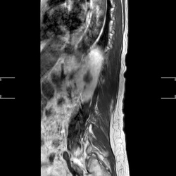 MRI_MobiView_Sag_T1W_TSE_603