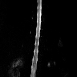 MRI_MYELO_radial_1101