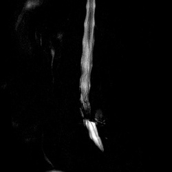 MRI_MYELO_radial_1201